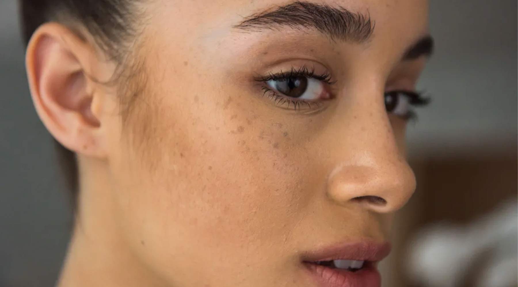 Hyperpigmentation The Complete Lowdown