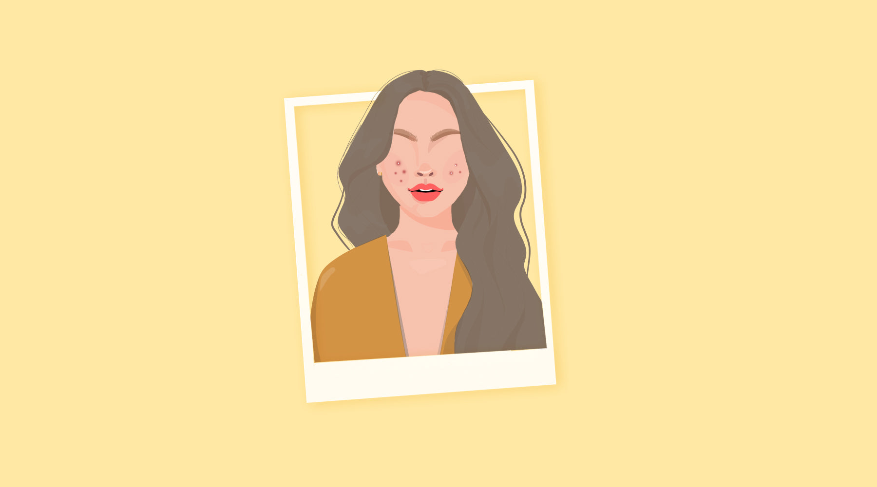 How To Get Rid Of Cystic Acne Easily - Skincare Routine & Tips