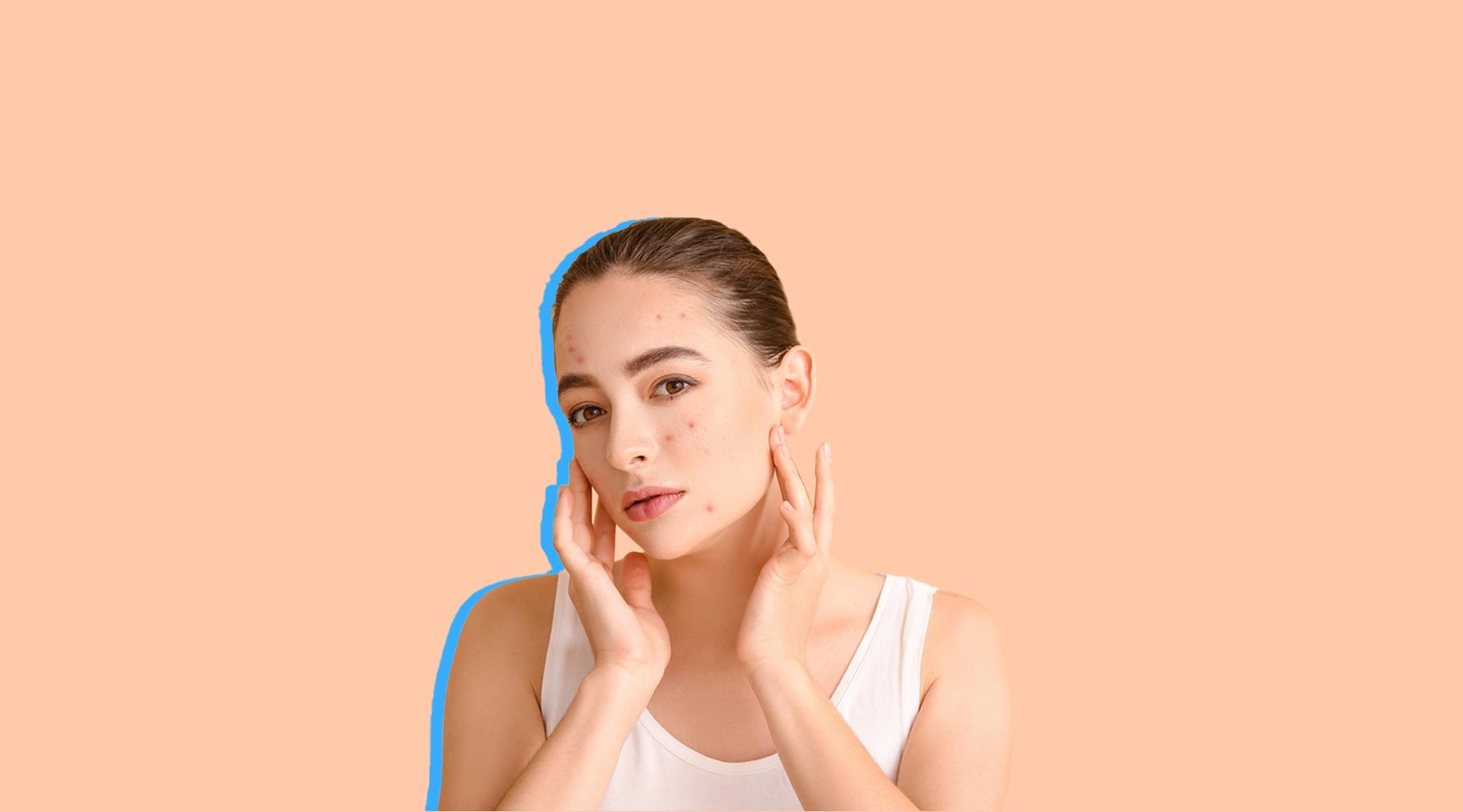 5 Skincare Ingredients That Reduce Hormonal Acne