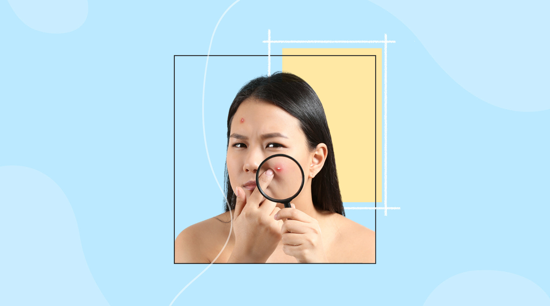 What is adult acne and how to deal with it