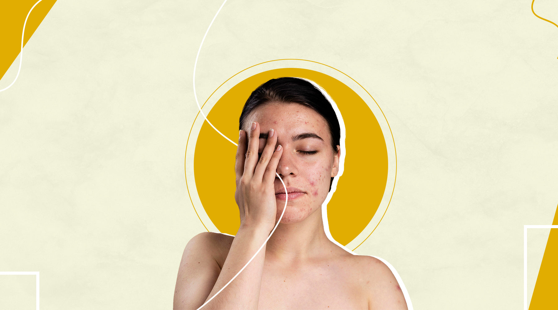 What is hormonal acne and how to treat it