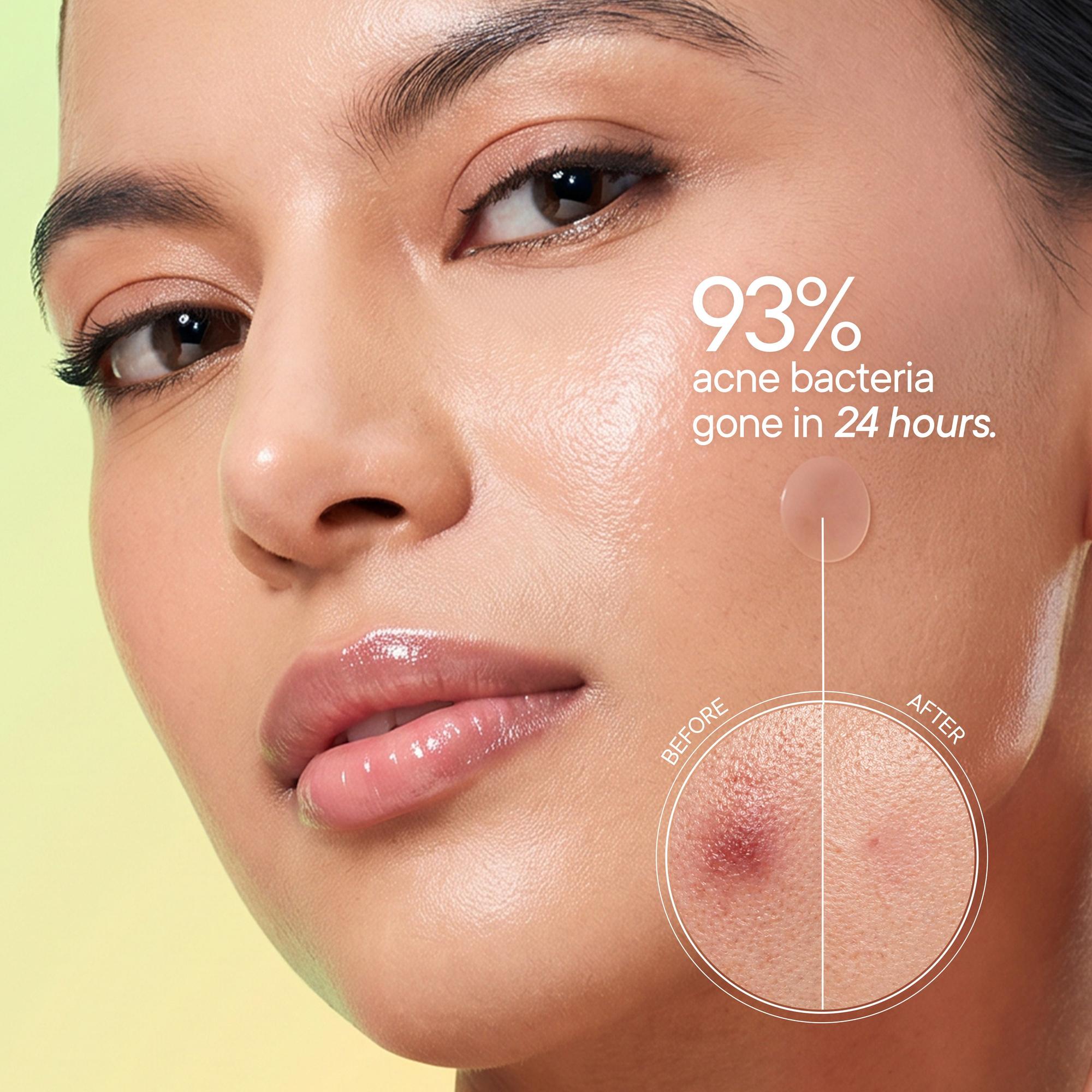Zit Away Treatment Patches with Cica Herb Repair - 24 PATCHES