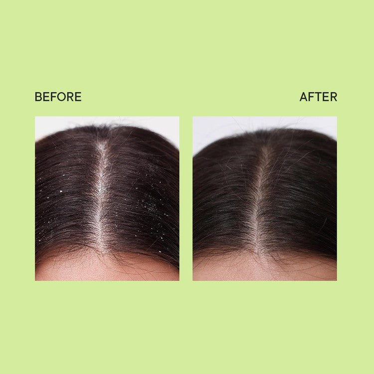 Dandruff Control Ampoule with Tea Tree Extracts - 100 ML