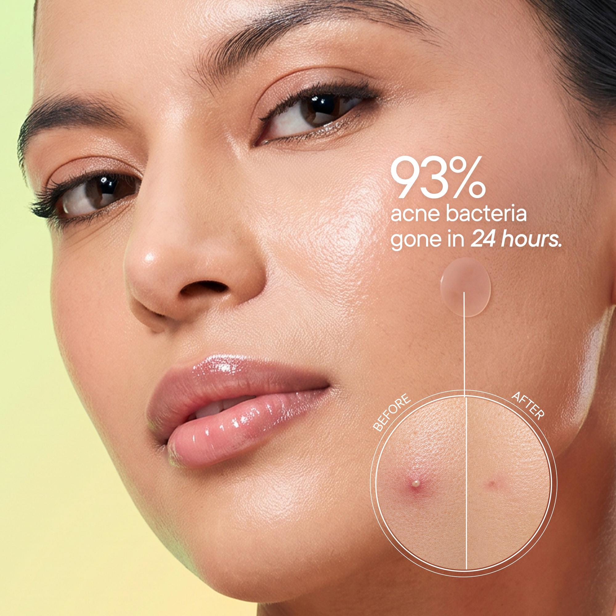 Zit Away Treatment Patches with Cica Herb Repair - 24 PATCHES