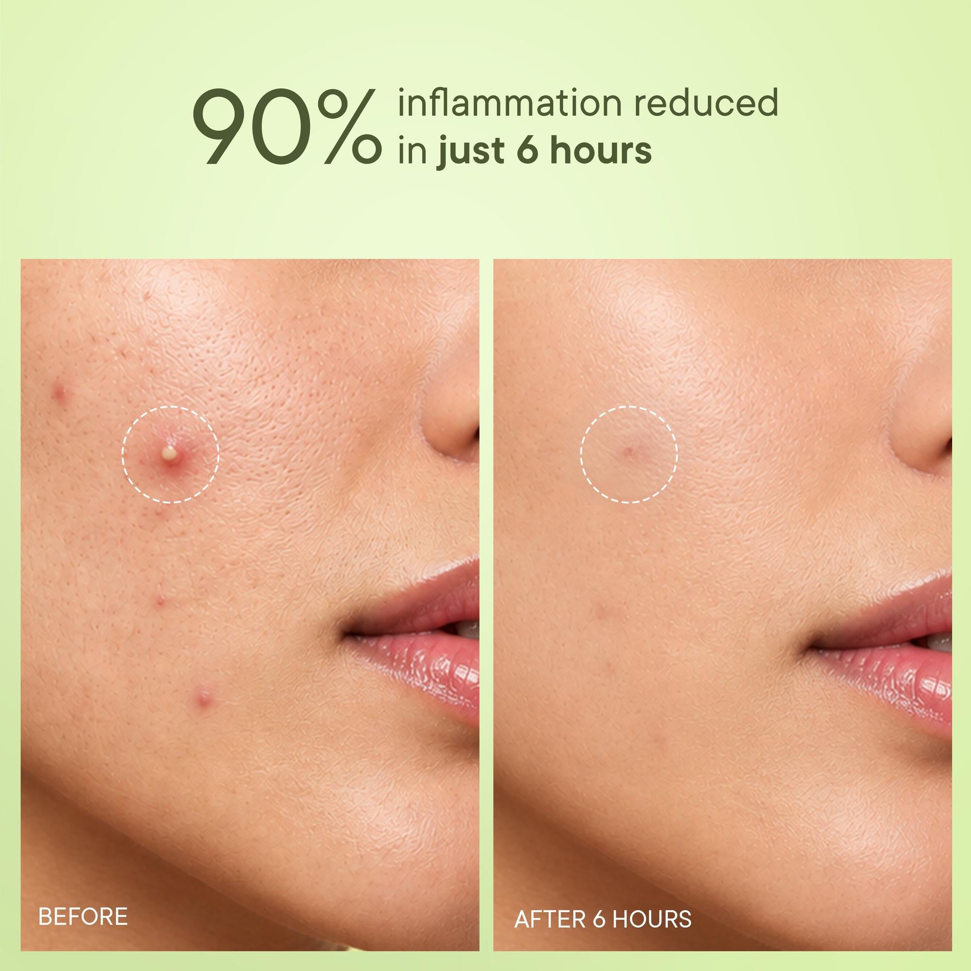 Zit Away Treatment Patches with Cica Herb Repair - 24 PATCHES