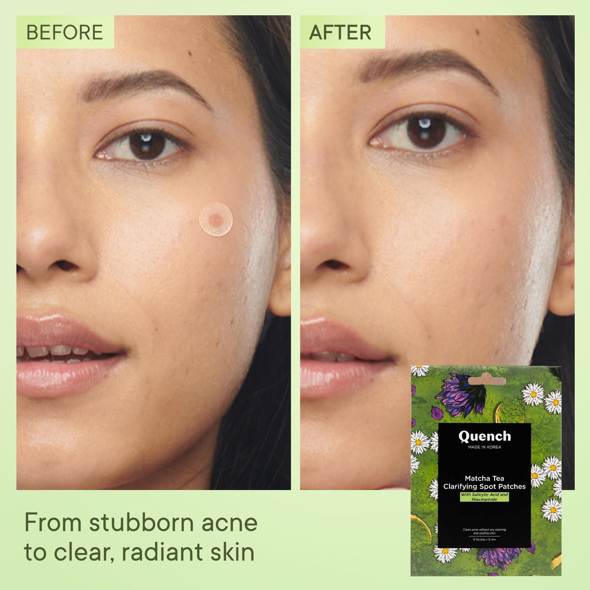 Matcha Pimple Patch for Acne Spots | Quench Botanics