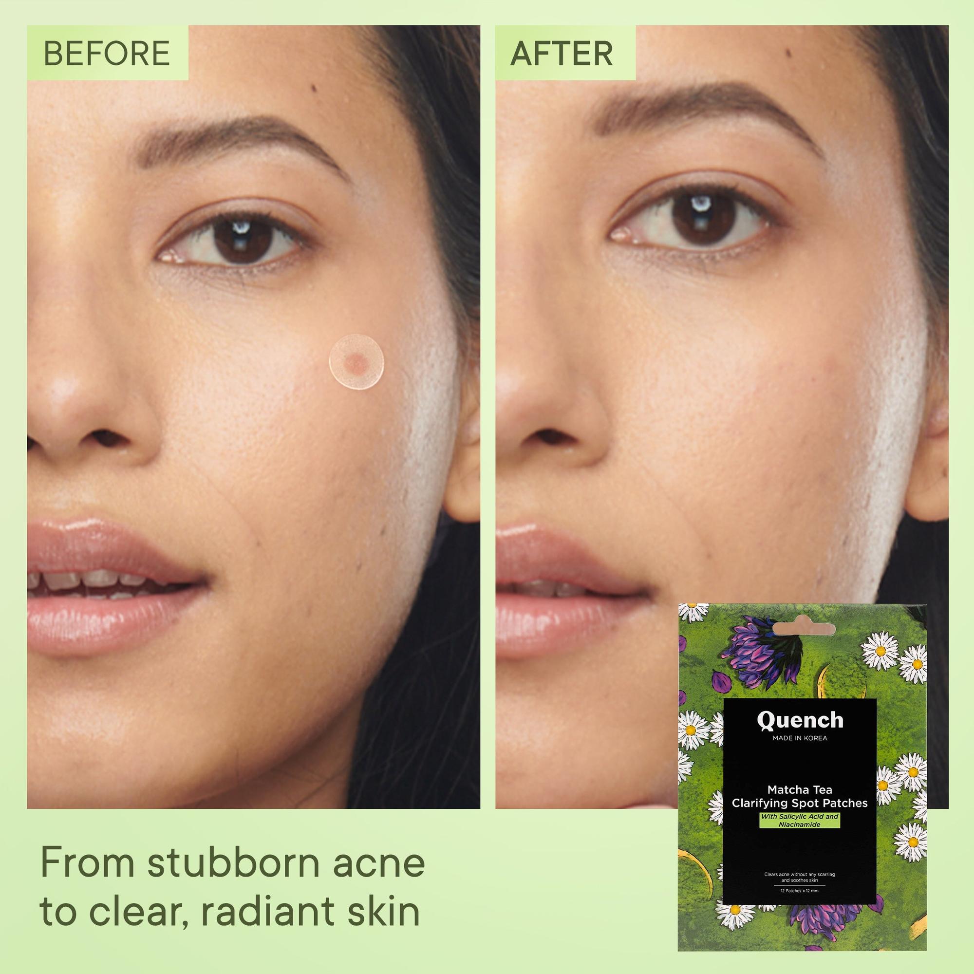 Matcha Tea Clarifying Acne Patches