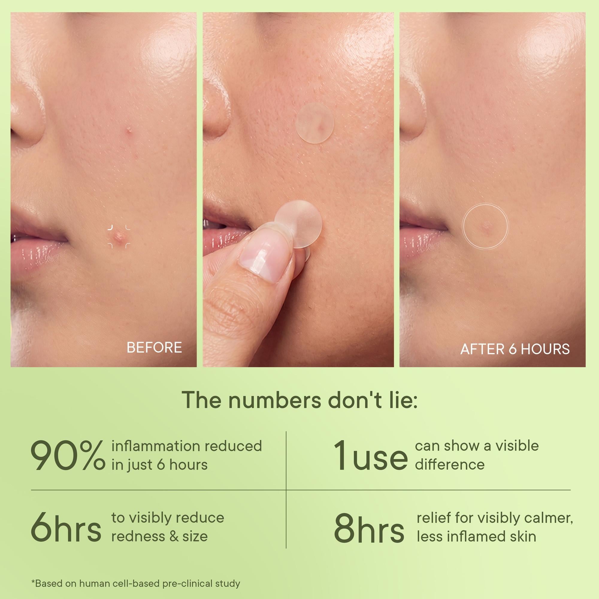 Zit Away Treatment Patches with Cica Herb Repair - 24 PATCHES
